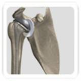 joint-replacement-of-other-joint1