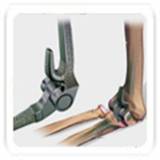 joint-replacement-of-other-joint2
