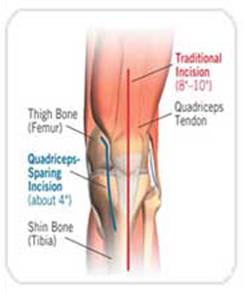 Minimally-Invasive-knee-Replacement