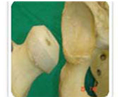 bone model before hip-resurfacing