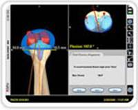 computer-assisted-joint-replacement-clip6