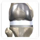 total knee replacement2