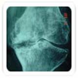 total knee replacement3