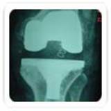 total knee replacement4