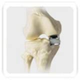 unicondylar knee replacement2