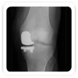 unicondylar knee replacement3