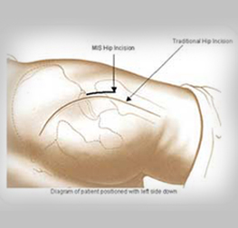 Minimally-Invasive-Hip-Replacement