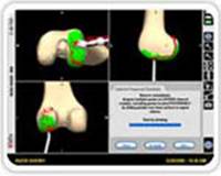 computer-assisted-joint-replacement-clip1