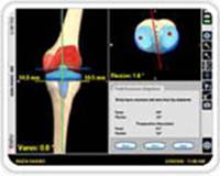 computer-assisted-joint-replacement-clip5